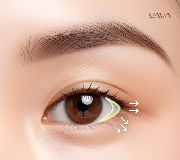 뒤밑트임 수술, 잘 되는 눈 따로 있습니다｜추천 대상&middot;부작용&middot;재유착 정리 관련 이미지 6