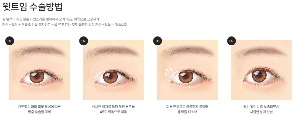 If You’re Concerned About a Tight-Looking Eye Shape | When Medial Epicanthoplasty & Upper Epicanthoplasty Are Needed and How They Differ at 바바성형외과 image 10