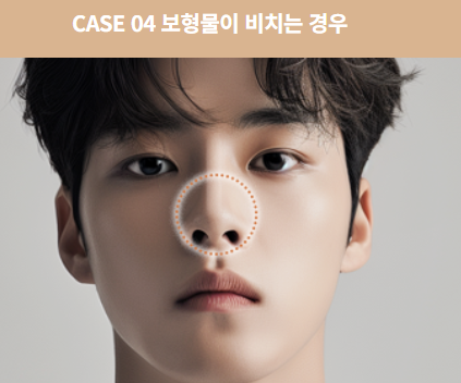 코 재수술, 첫 수술보다 더 신중해야 하는 이유 관련 이미지 9