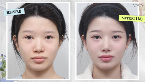 압구정 바바성형외과 자가늑 코성형 후기｜복코&middot;매부리코 교정 한달차 변화 관련 이미지 1