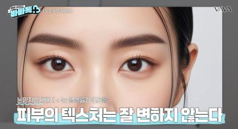 눈밑지방재배치 vs 하안검 vs 필러, 나는 어떤 케이스일까? | 압구정 바바성형외과에서 알려드립니다 관련 이미지 8