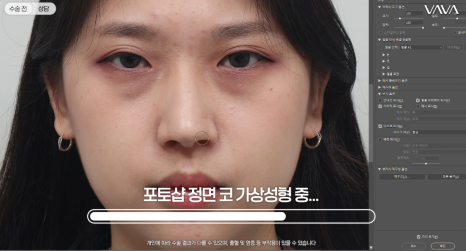 눈이랑 코 같이 하면 더 예뻐질까? ㅣ  동시성형 솔직 정리 관련 이미지 5