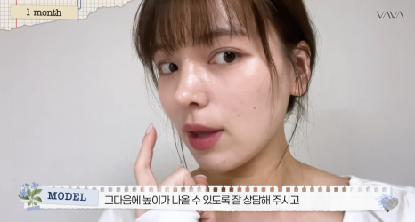 보형물 없이 선명하게｜바바성형외과 무보형물 매부리코 교정 리얼 후기 관련 이미지 17