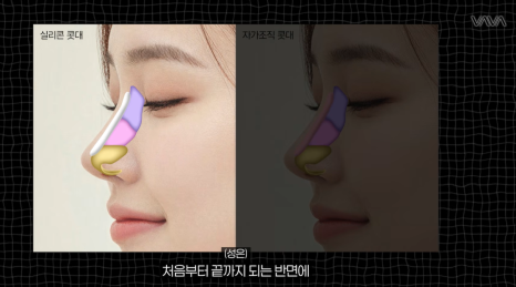 코성형 재료 총정리｜실리콘 부작용&middot;자가늑연골 와핑&middot;귀연골 흡수까지 (콧대 코끝 비교) 관련 이미지 5