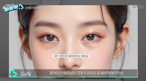 눈밑지방재배치 vs 하안검 vs 필러, 나는 어떤 케이스일까? | 압구정 바바성형외과에서 알려드립니다 관련 이미지 10