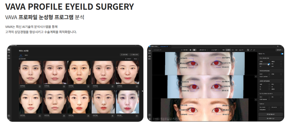 Revision Double Eyelid Surgery May Not Be Just a Line Issue | When Revision Eyelid Surgery Is Needed at Baba Plastic Surgery image 9