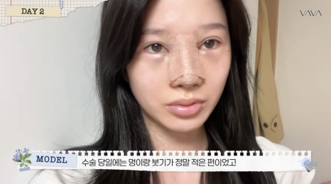 압구정 바바성형외과 자가늑 코성형 후기｜복코&middot;매부리코 교정 한달차 변화 관련 이미지 14