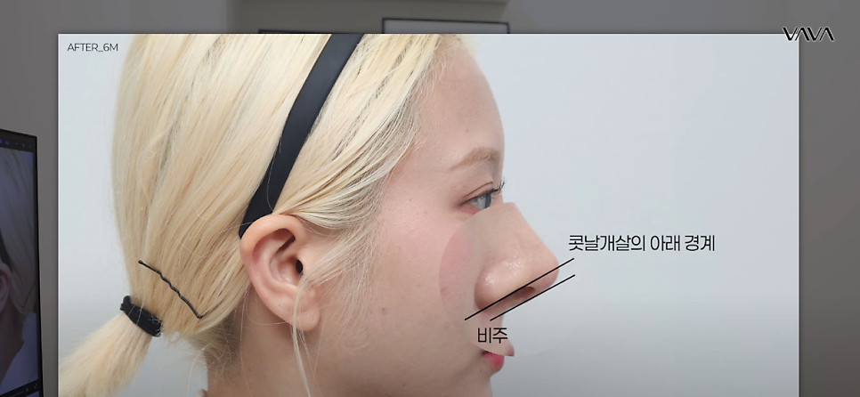 코재수술 원인, 과연 코끝처짐만이 문제일까? 가장 이상적인 라인 알려드립니다 관련 이미지 25
