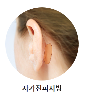 입체적이고 균형 잡힌 코 라인을 위한 자가연골 코 성형(비중격, 귀연골, 늑연골) 관련 이미지 8