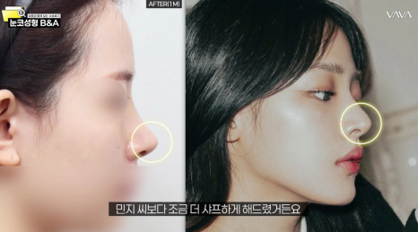 복코 매부리코 긴코 교정 ㅣ 코성형 전후 케이스 (NJZ민지 코) 관련 이미지 5