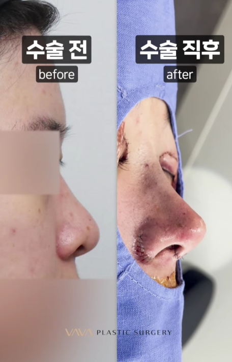 화려와 자연스러움의 중간 자려라인의 정석 직반라인 코 성형 관련 이미지 11