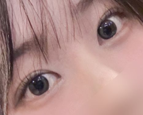 여름철 휴가 전 쌍꺼풀 수술 붓기 관리와 회복 TIP 관련 이미지 13