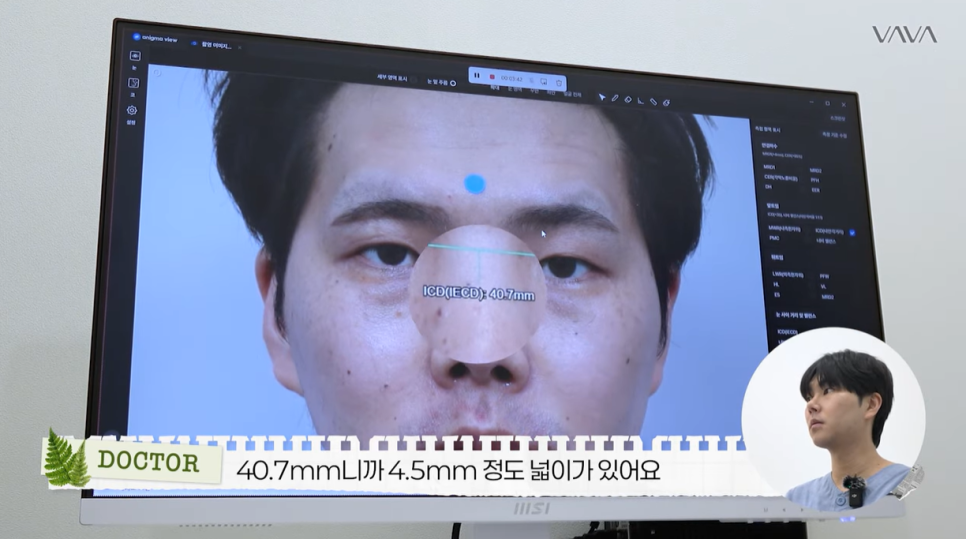 눈&middot;구축코 재수술 후기｜남자 눈코 재수술, 압구정 바바에서 달라진 이유 관련 이미지 6