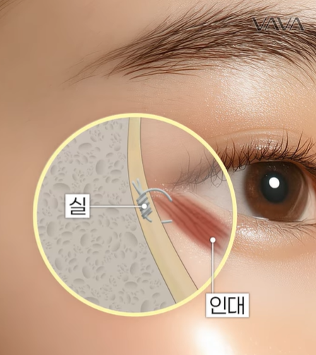 뒤밑트임 수술, 잘 되는 눈 따로 있습니다｜추천 대상&middot;부작용&middot;재유착 정리 관련 이미지 10