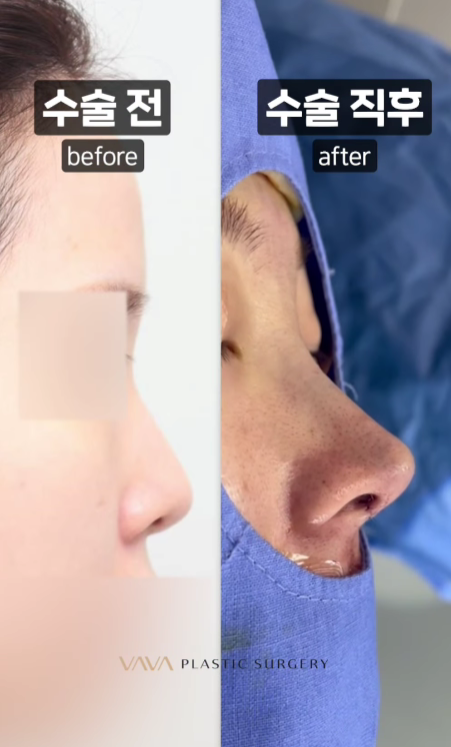 화려와 자연스러움의 중간 자려라인의 정석 직반라인 코 성형 관련 이미지 10