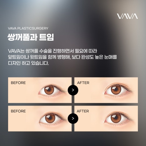 절개 눈성형 방법과 절개가 필요한 눈 유형 관련 이미지 7