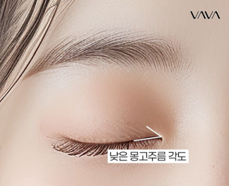 자연유착 VS 절개  어떤 기준으로 선택해야 할까? 관련 이미지 16