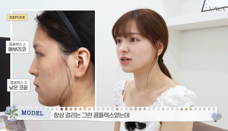보형물 없이 선명하게｜바바성형외과 무보형물 매부리코 교정 리얼 후기 관련 이미지 19
