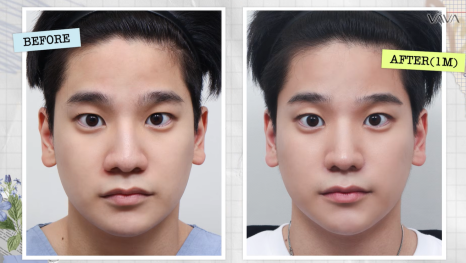 무보형물 직선라인 코성형으로 주먹코&middot;복코 개선｜압구정 바바성형외과 사례 관련 이미지 1