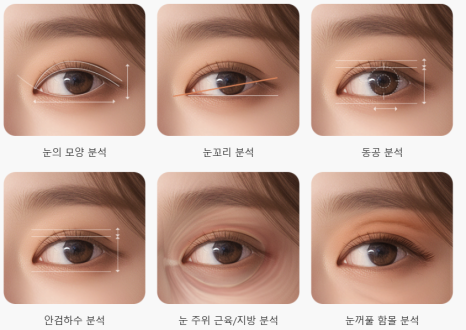 졸려 보이는 눈 안검하수 절개 쌍수 전후 차이 관련 이미지 9