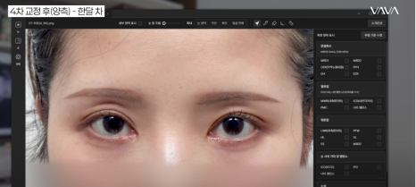 쌍수 후 생겨버린 짝눈 교정 눈의 균형을 맞추는 섬세한 방식 관련 이미지 20