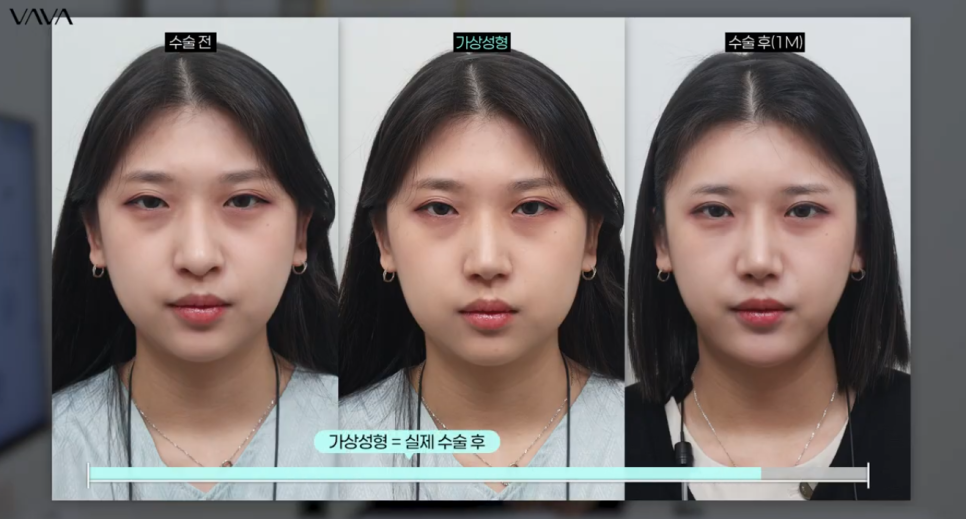 코수술 전 포토샵으로 결과를 확인하는 이유 ㅣ 바바성형외과 코수술 가상성형 상담 관련 이미지 10