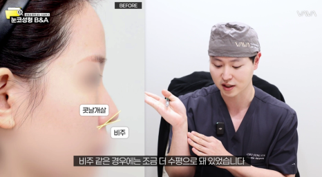 복코 매부리코 긴코 교정 ㅣ 코성형 전후 케이스 (NJZ민지 코) 관련 이미지 18