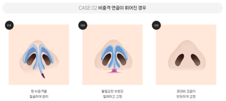 복코, 매부리코, 낮은코 | 바바성형외과 유형별 코성형, 내 코에 맞는 방향 찾기 관련 이미지 17