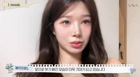 압구정 바바성형외과 자가늑 코성형 후기｜복코&middot;매부리코 교정 한달차 변화 관련 이미지 19