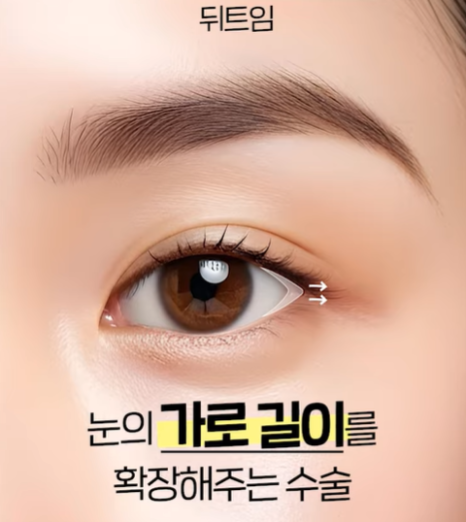 뒤밑트임 수술, 잘 되는 눈 따로 있습니다｜추천 대상&middot;부작용&middot;재유착 정리 관련 이미지 3