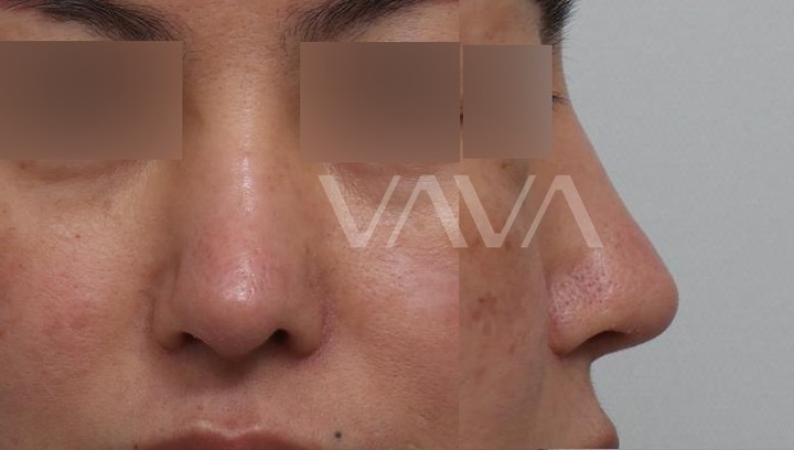 첫 재수술 실패로 잃어버린 코 라인 되찾기 관련 이미지 2