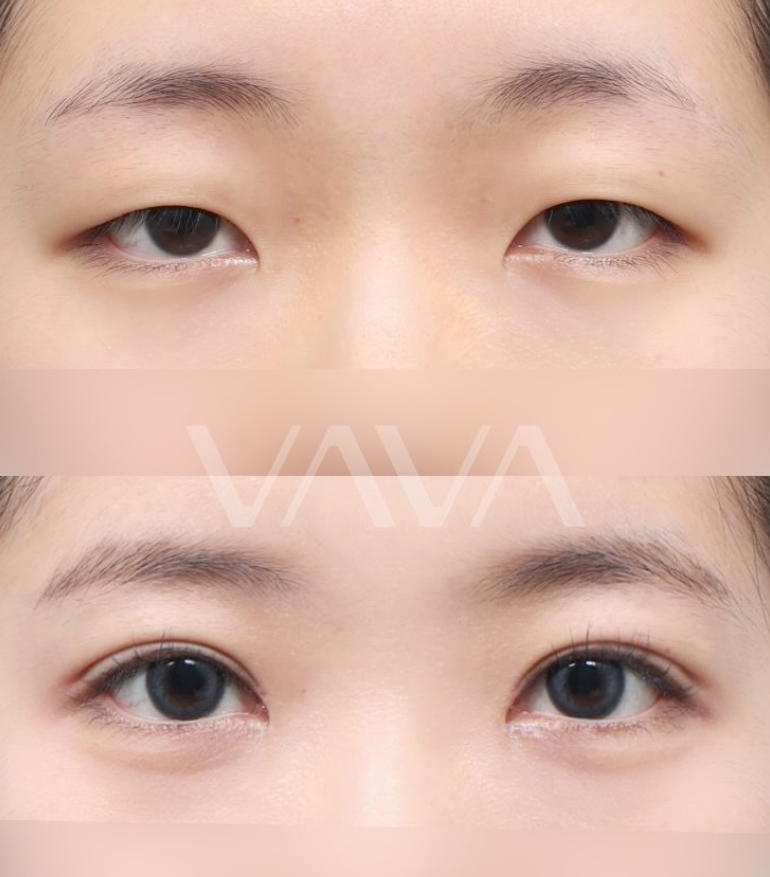 세미아웃라인 쌍수 장원영 쌍꺼풀 분석해 보기 관련 이미지 12