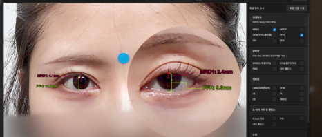 쌍수 후 생겨버린 짝눈 교정 눈의 균형을 맞추는 섬세한 방식 관련 이미지 4