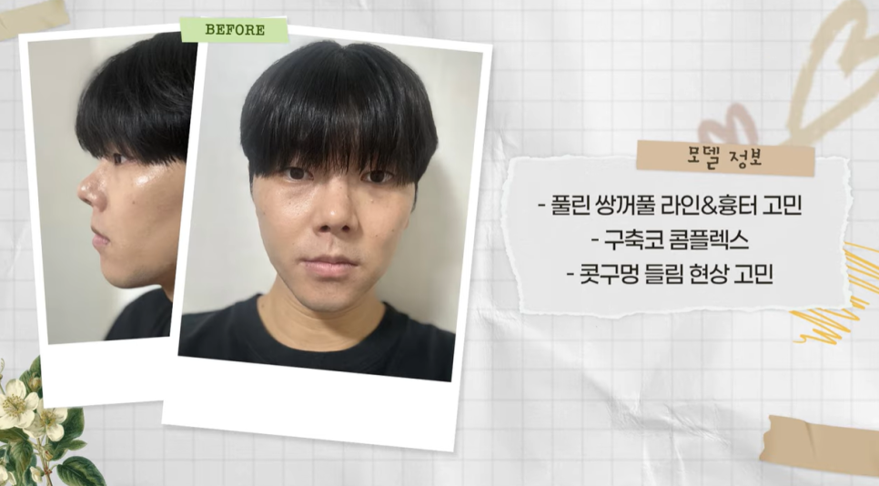 눈&middot;구축코 재수술 후기｜남자 눈코 재수술, 압구정 바바에서 달라진 이유 관련 이미지 19