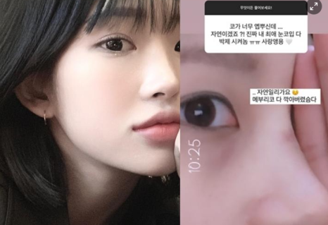 최준희 코 재수술 눈 재수술 성형 분석 관련 이미지 4