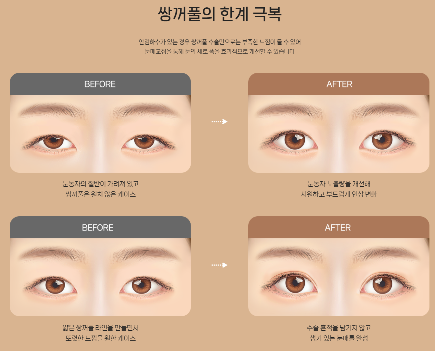 졸려 보인다는 말 자주 듣는다면? | 바바성형외과 눈매교정이 필요한 경우 관련 이미지 7