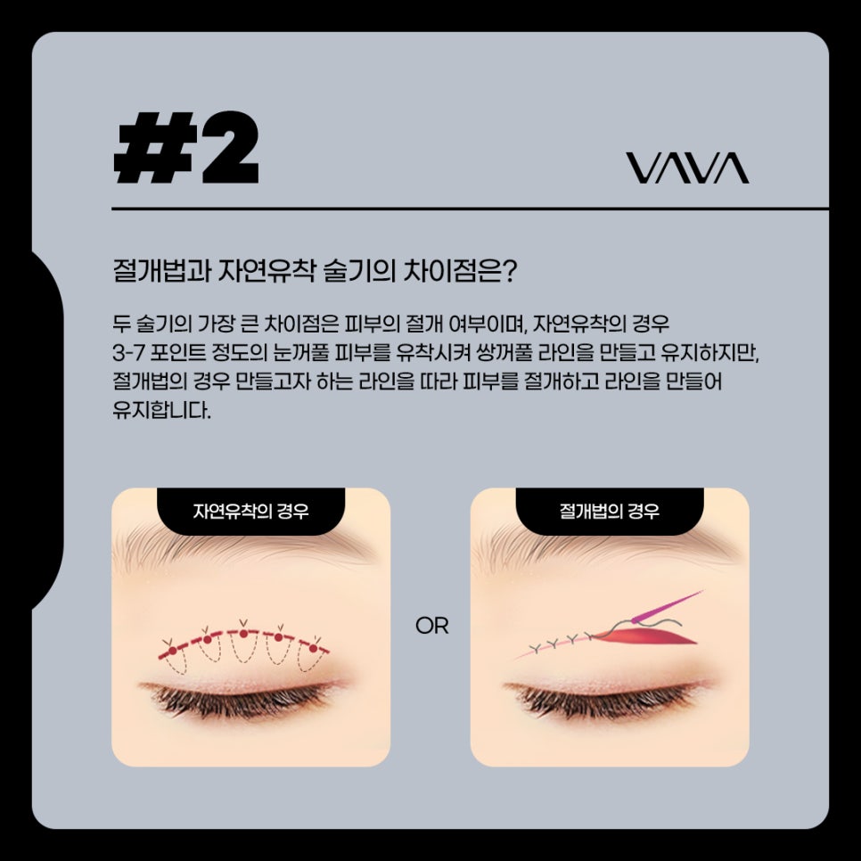 자연유착 쌍꺼풀 내게 어울리는 비율로 관련 이미지 2