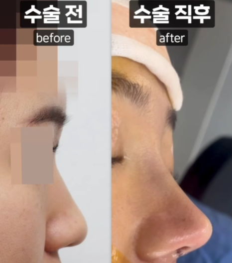 코끝 처짐 없이 자연스러운 맞춤 라인으로 관련 이미지 2