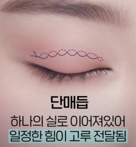 나에게 맞는 쌍꺼풀 수술법 총정리 : 절개, 부분절개, 매몰법까지 관련 이미지 3