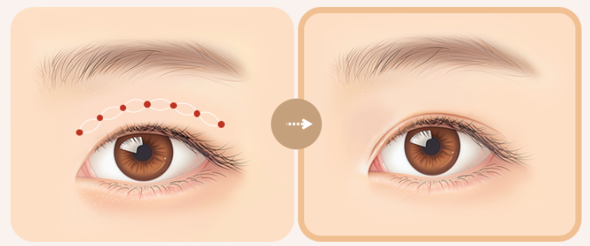 쌍꺼풀 수술 종류 비절개 vs 절개 vs 부분 절개 관련 이미지 6
