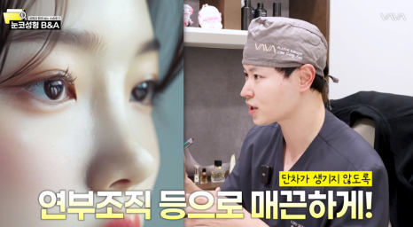 복코 매부리코 긴코 교정 ㅣ 코성형 전후 케이스 (NJZ민지 코) 관련 이미지 23