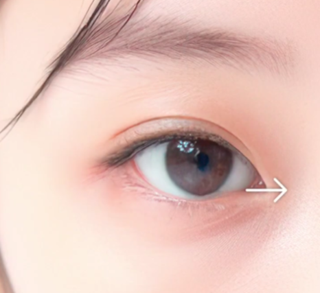 쌍수만으로 충분할까? 윗트임 병행이 필요한 경우 관련 이미지 3