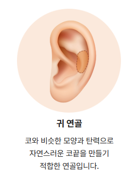 코성형 재료 어떤게 좋을까? ㅣ 코성형 재료의 모든 것, 코 재료 총정리 관련 이미지 7