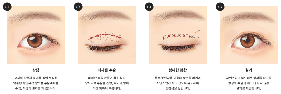 쌍꺼풀 수술 짧은 회복기 가능? 종류별 차이 완전 정리 관련 이미지 5