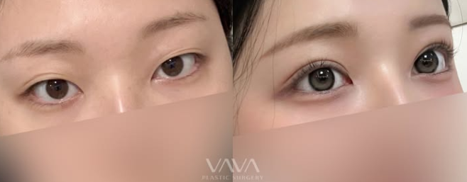 쌍꺼풀 수술만으로 충분할까? 눈 트임이 필요한 경우 관련 이미지 10