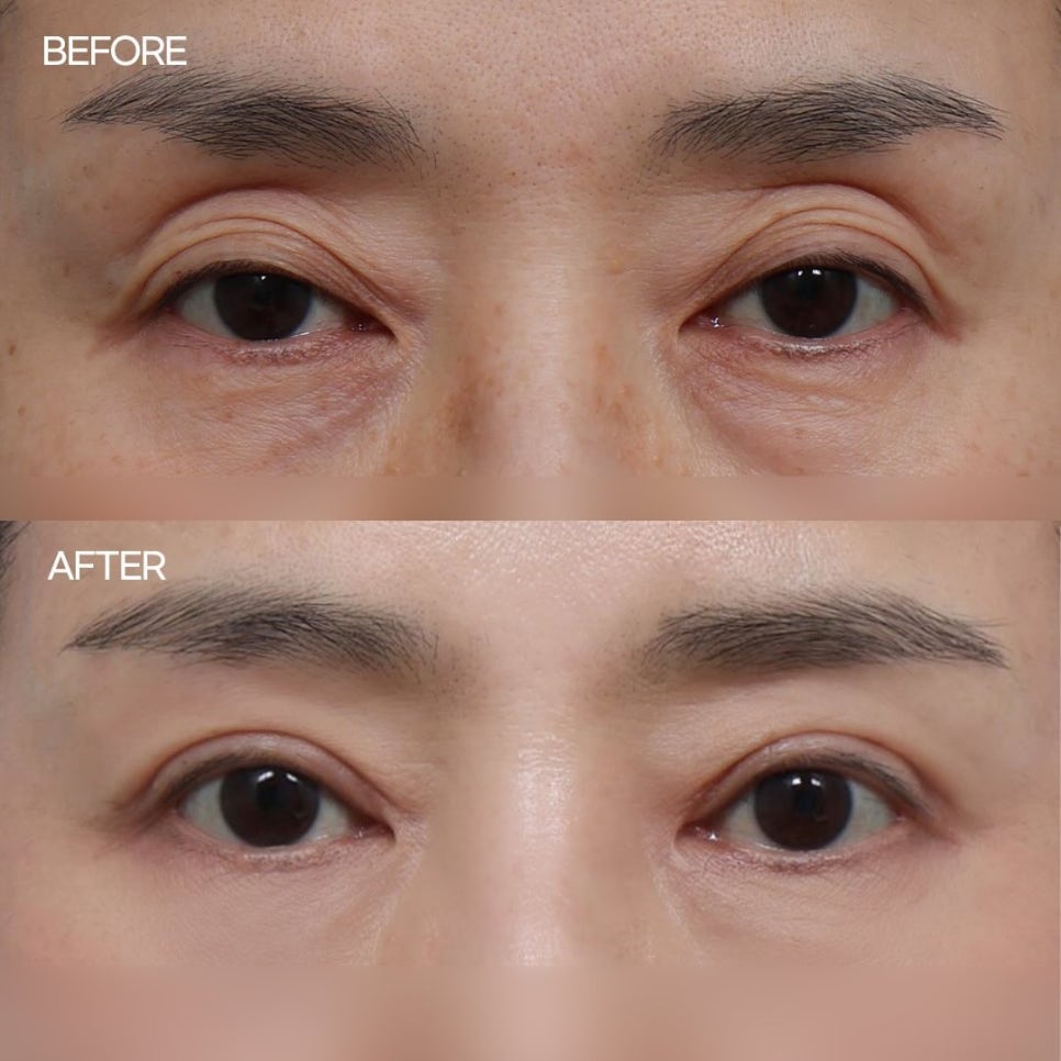 눈 유형별 맞는 쌍수 알아보기 관련 이미지 4