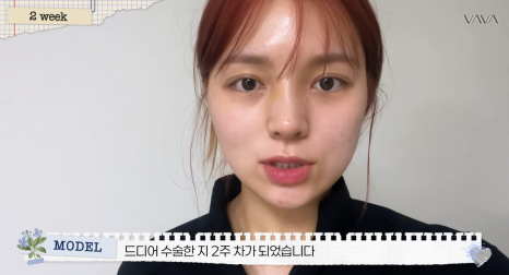 보형물 없이 선명하게｜바바성형외과 무보형물 매부리코 교정 리얼 후기 관련 이미지 14