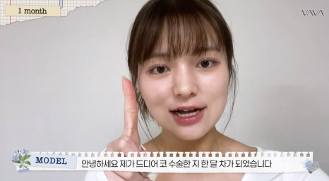 보형물 없이 선명하게｜바바성형외과 무보형물 매부리코 교정 리얼 후기 관련 이미지 16