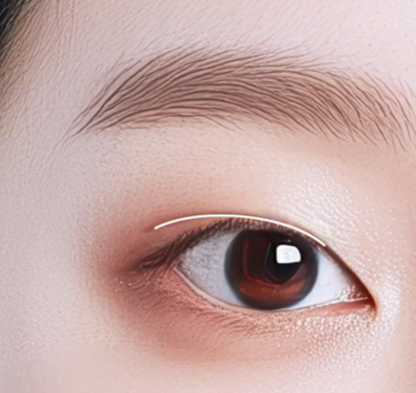 쌍수만으로 충분할까? 윗트임 병행이 필요한 경우 관련 이미지 9