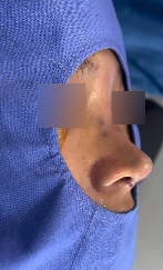 복코 수술전후 개선 된 인상 관련 이미지 4